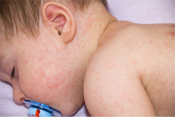 Allergies in children