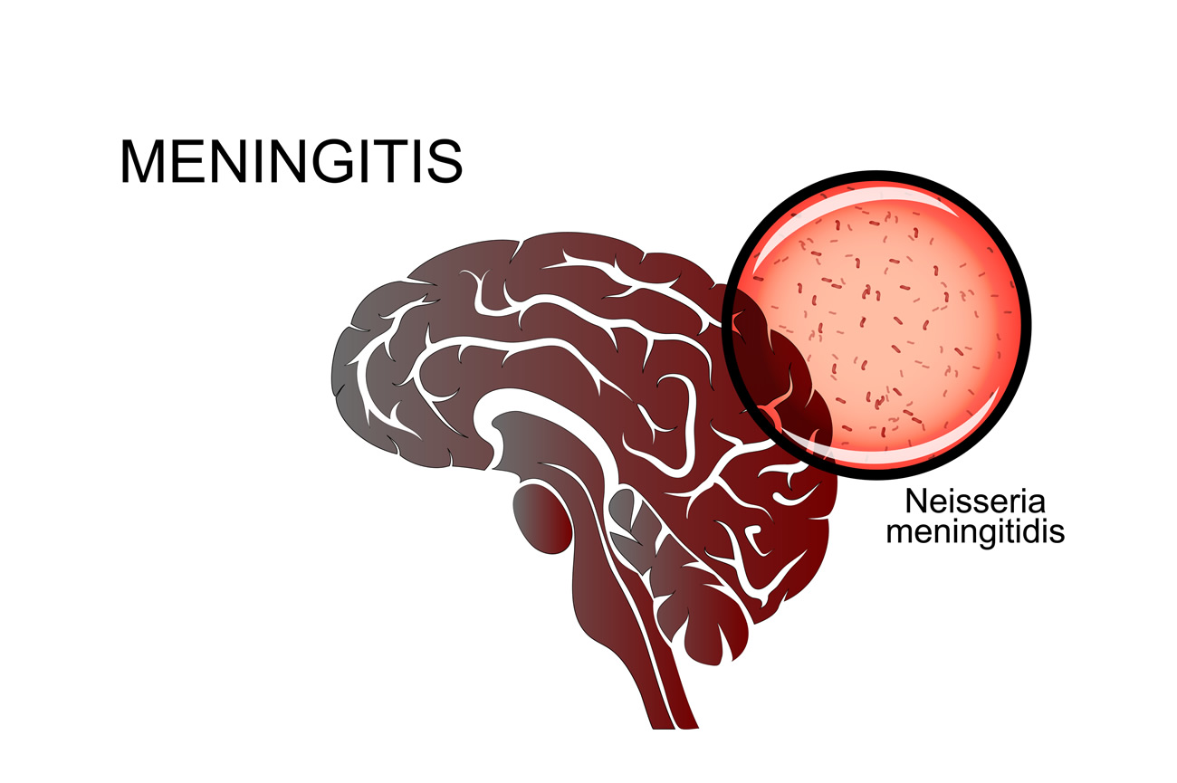 neisseria-meningitidis