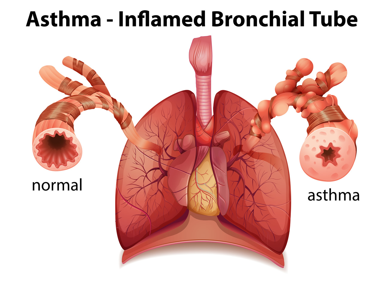 asthma-inflamed-bronchial-tube