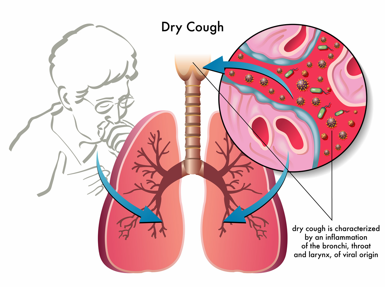 dry-cough