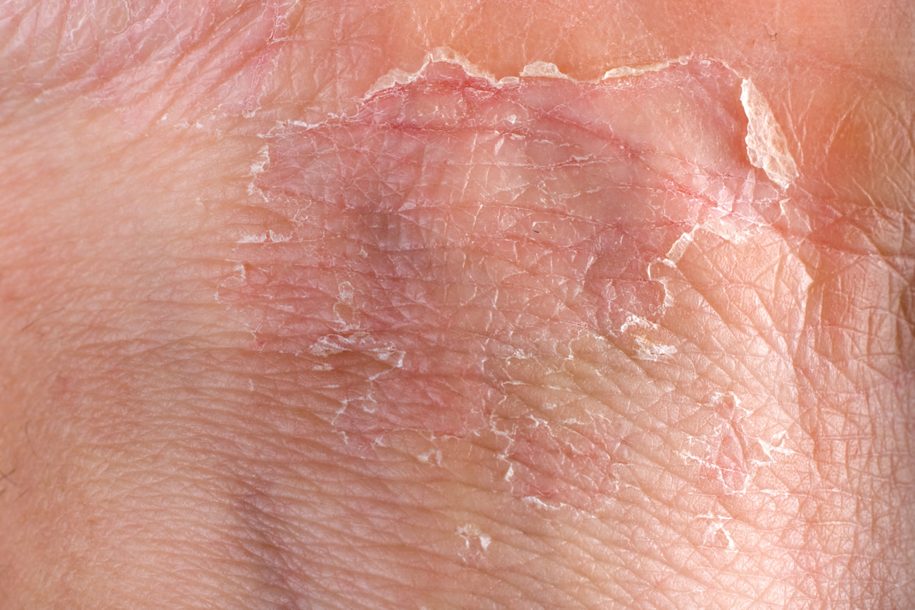 allergies-in-children-eczema