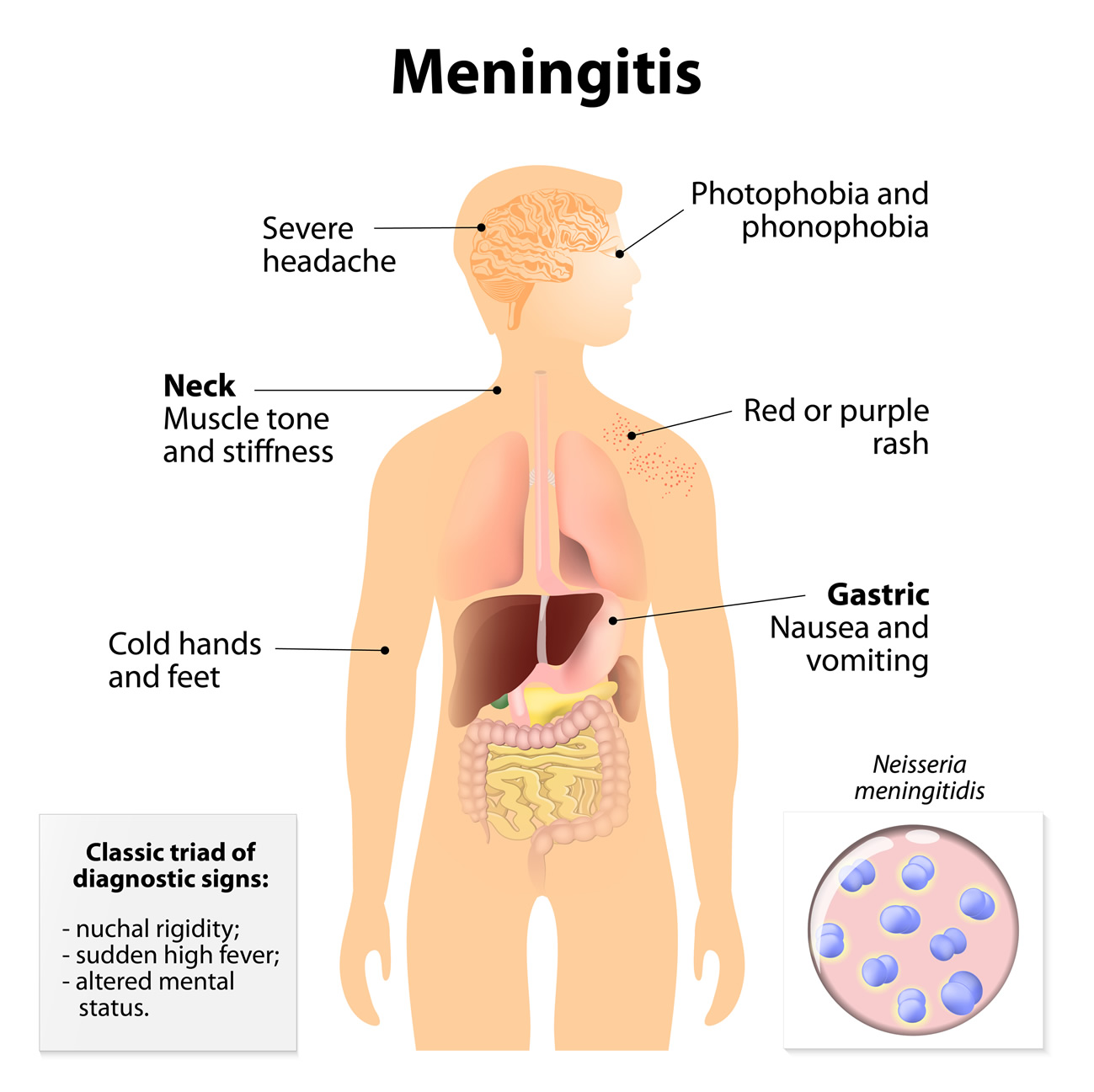 meningitis-signs