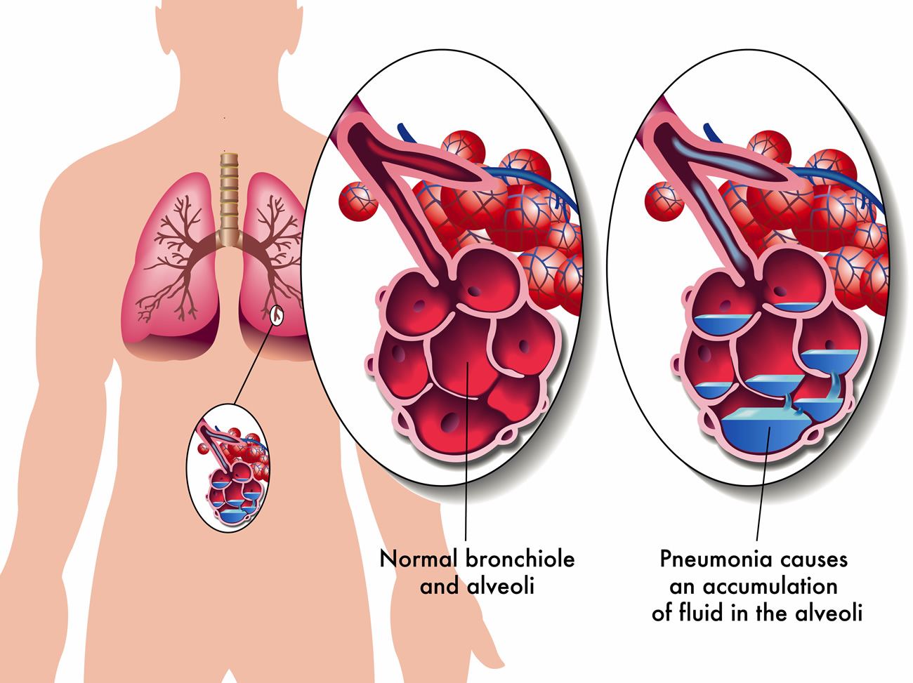 pneumonia-in-children